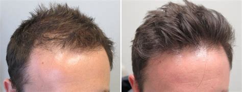 150+ Progress Photos of Finasteride + Minoxidil with Ages Listed : r ...