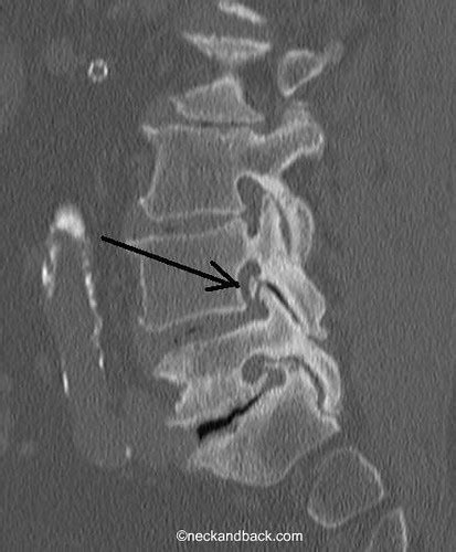 Foraminal Stenosis Of The Spine Bone Spur Dr Donald C Flickr