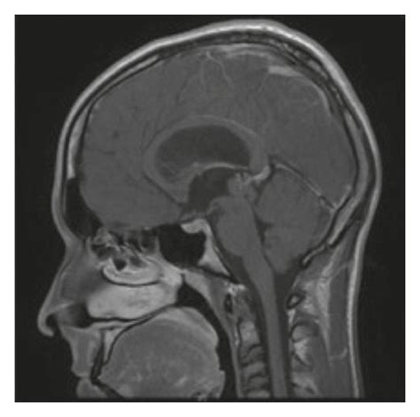 CT scan and MRI at admission documented acute obstructive hydrocephalus ...