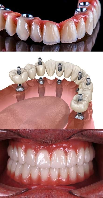 Refaire Ses Dents Exemples D Taill S Prix