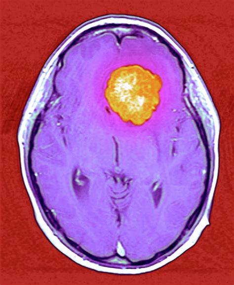 Brain Tumour By Simon Fraser Royal Victoria Infirmary Newcastle Upon