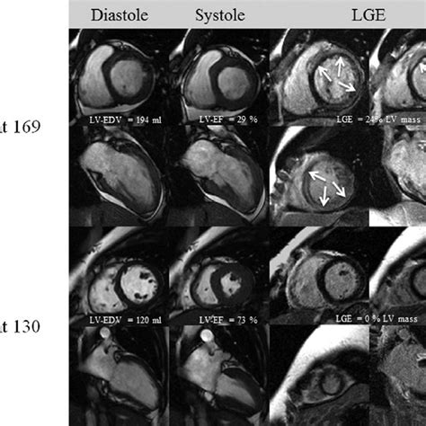 Typical Cardiac Magnetic Resonance Results Cardiovascular Magnetic