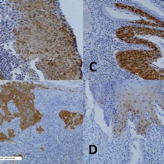 Photomicrograph Showing P16 INK4a Scoring Via Immunohistochemistry