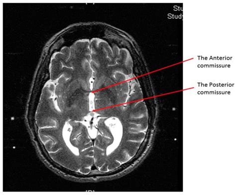 Brain Sciences Free Full Text Using Functional Target Coordinates