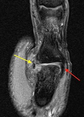 Ulnar Collateral Ligament Tear Wrist