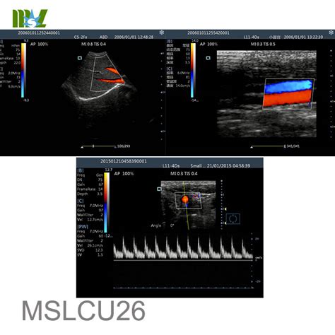 Color Doppler Ultrasound Principles And Advantages