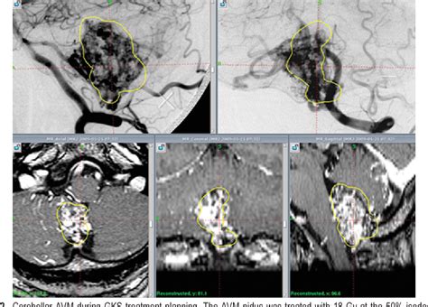 Figure 2 From Stereotactic Radiosurgery For Arteriovenous Malformations Of The Cerebellum