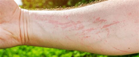 Urticaria Crónica ronchas guía para los que sufren La Asociación