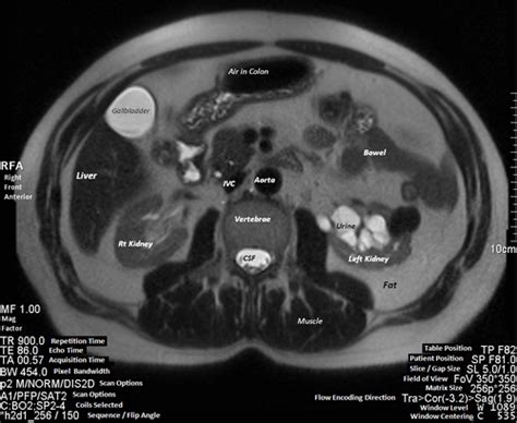 Mri Program Labeled Diagram Flashcards Quizlet