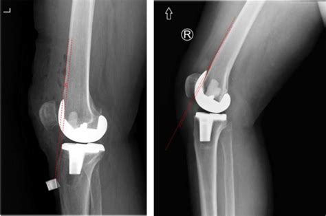 Does The Anatomic Design Of Total Knee Prosthesis Allow For A Better