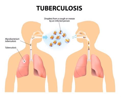 What are the signs and symptoms of TB?