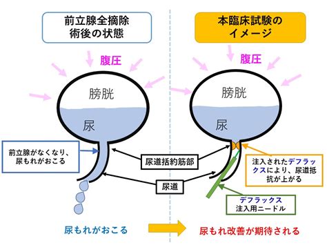 前立腺癌術後の尿もれに対する新しい治療の臨床試験 京都府立医科大学泌尿器科学教室