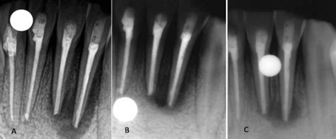 A Immediate Postoperative Periapical Radiograph Showing Periapical