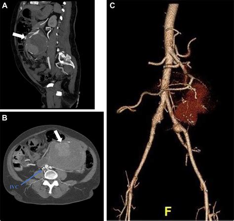 Superior Mesenteric Artery Aneurysm Endovascular Repair Journal Of