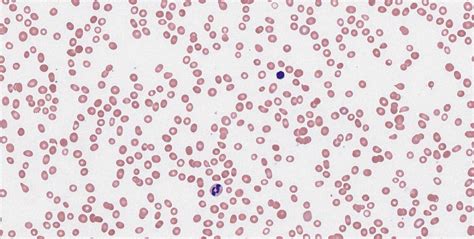 Aplastic Anemia Virtual Slides