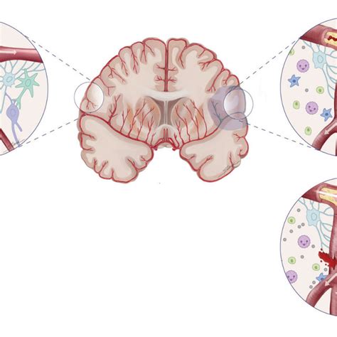 (PDF) Cerebral Autoregulation in Ischemic Stroke: From Pathophysiology to Clinical Concepts