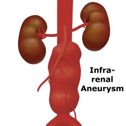 Abdominal aortic aneurysm - UF Health