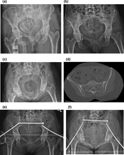 Case Example— A Middle Aged Woman With A High Energy Lc1 Fracture And Download Scientific