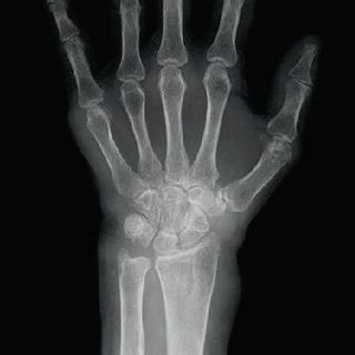 Anterior Posterior Plain Radiographs Showing Bone Atrophy Around The