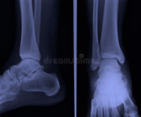 X Ray Ankle Ap Lateral Stock Photos Free Royalty Free Stock Photos