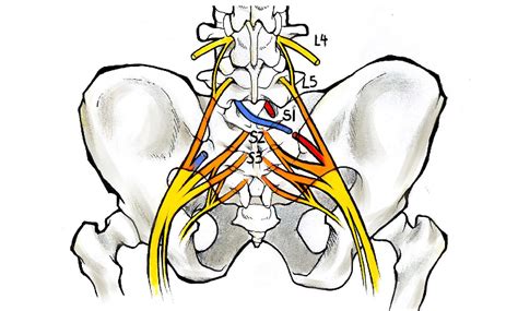 Illustration of the contralateral S1 nerve root transfer surgery ...