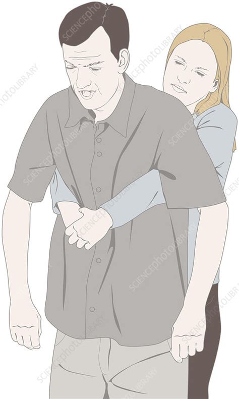 Heimlich Manoeuvre Illustration Stock Image C039 2558 Science Photo Library