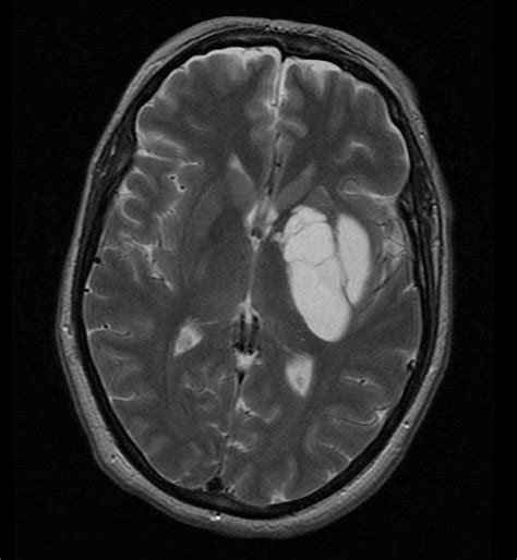 What is this important basal ganglia lesion? ... | Radiopaedia.org