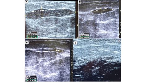 The healing of granulomatous mastitis lesion in 42 years old patient.A;... | Download Scientific ...