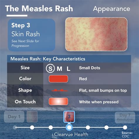 Recognizing Measles: Key Symptoms and Features