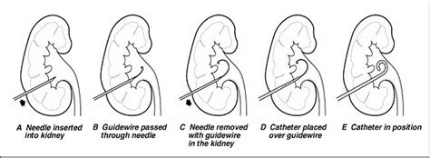 Nephrostomy Tube Ultrasound