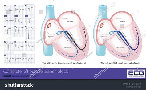 Complete Left Bundle Branch Block Conduction Stock Illustration