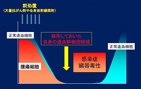 造血幹細胞移植｜慶應義塾大学病院 Kompas