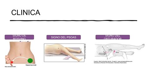 APENDICITIS AGUDA CIRUGIA GENRERAL CLASE PPT