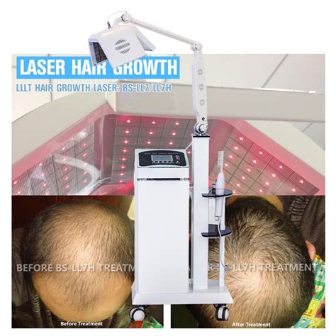 La Terapia Del Laser De La Terapia LLLT Del Pelo Crece El Pelo Con La