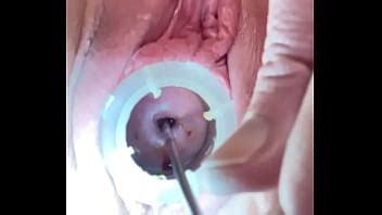 Cervix Dilation Videos XVIDEOS