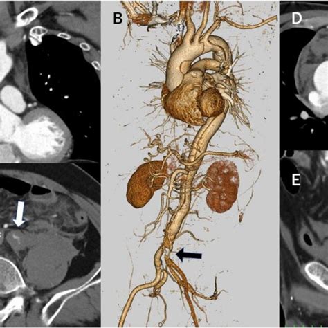 Preoperative Computed Tomography A Acute Type A Aortic Dissection