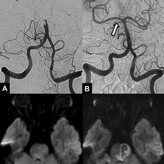 A 64-year-old female patient with acute stroke due to basilar artery... | Download Scientific ...