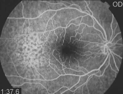 Retinopatía traumática bilateral asociada a latigazo cervical