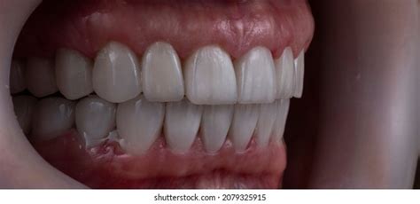 Teeth Indirect Restorations By Ceramic Crowns Stock Photo 2079325915