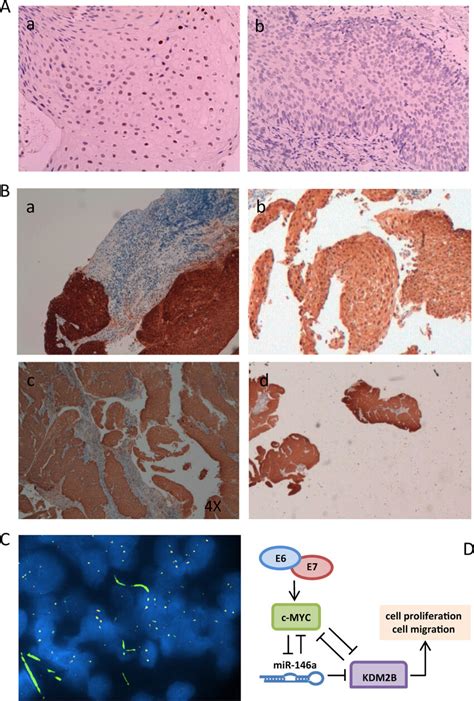 Expression Of Kdm2b In Hpv Related Cancer A Chromogenic In Situ Download Scientific Diagram