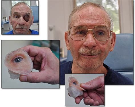 Hemifacial Cosmetic Prosthesis Reallifeskin™ Reallifeskin Orbital