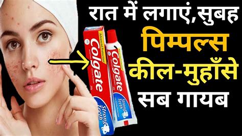 मुहांसो से जड़ से छुटकाराpimples Thik Karne Ke Gharelu Upayacne