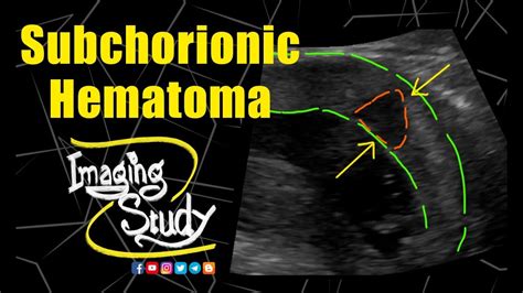 Subchorionic Hematoma Ultrasound Case Youtube