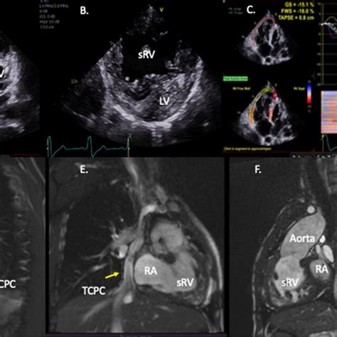 Imaging Assessment Of A Patient With Hypoplastic Left Heart Syndrome Download Scientific