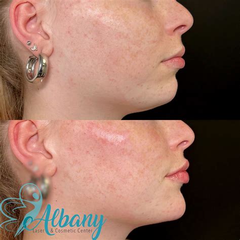 Dermal Fillers Edmonton Albany Cosmetic And Laser Center