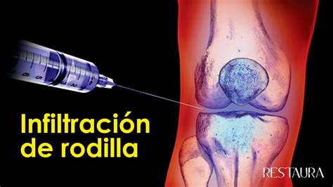 Infiltraci N De Rodilla Todo Lo Que Necesitas Saber Youtube