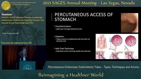 Percutaneous Endoscopic Gastrostomy Tubes - Types, Techniques and ...