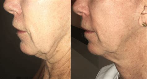 Non Surgical Facelift With Morpheus8 Women Medispa Physimed