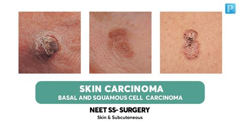 Skin Carcinoma Basal And Squamous Cell Carcinoma