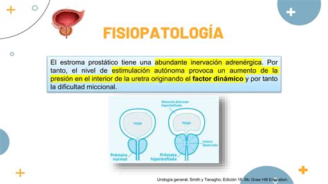 Hiperplasia Prost Tica Benigna Y C Ncer De Pr Stata Ppt